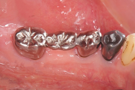 歯科　金属　パラジウム